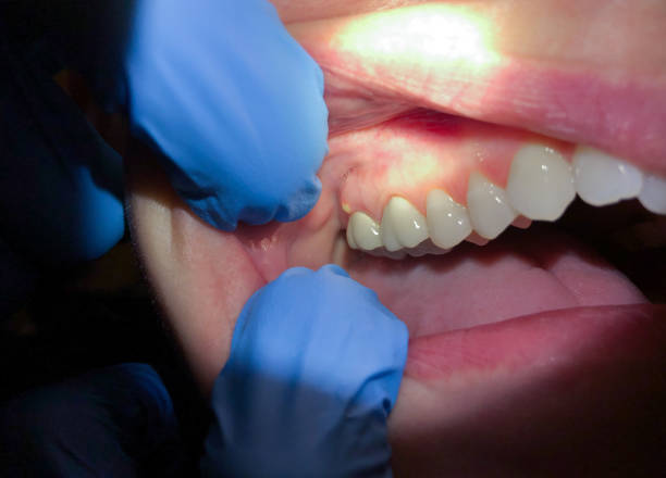 Best Teeth Whitening  in Roaming Shores, OH